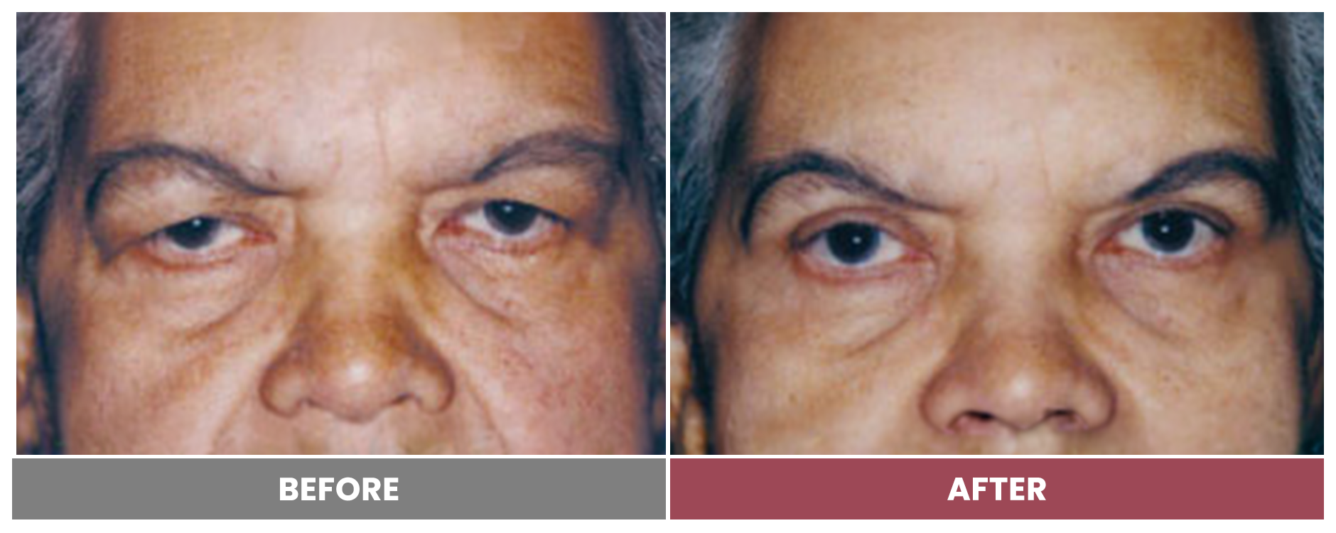 Upper Blepharoplasty - Case 70